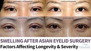 Temporary Swelling after Asian Double Eyelid Surgery  Factors that Affect Severity Healing Time [upl. by Menon]