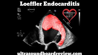 Loeffler Endocarditis Echocardiography [upl. by Hsur]