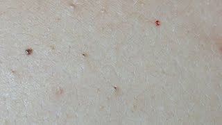 Acne Treatment on the Back Uninfected Lesions [upl. by Plossl]