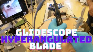 How to Intubate your patient with a GlideScope Hyperangulated Blade [upl. by Fasa]