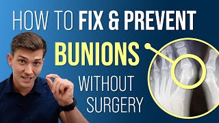 How to Fix amp Prevent Bunions Without Surgery [upl. by Radu]