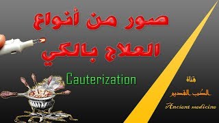 الكي  صور من أنواع العلاج بالكي  Cauterization [upl. by Navap]