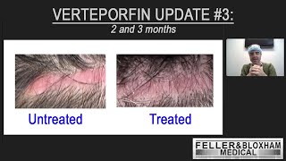 Verteporfin Update 3 Month 2 and 3  Dr Blake Bloxham  Feller amp Bloxham Medical  NYC LI [upl. by Claudia]