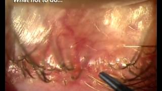 Demodex Blepharitis Is it for real [upl. by Orodoet654]