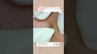 Big Cystic Acne Blackheads Extraction Blackheads amp Milia Whiteheads Removal Pimple Popping [upl. by Ahsilac]