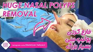 Huge Nasal Polyps Removal By Dr Shahriyar Yahyavi [upl. by Popelka]