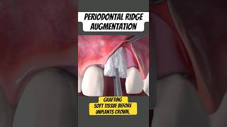 Ridge Augmentation Soft tissue Grafting Dental Implants [upl. by Yliah]