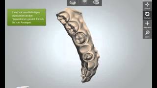 3shape Trios Intraoralscanner Workflow [upl. by Akeenat882]