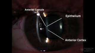 Slit Lamp Techniques Optical Section of Crystalline Lens [upl. by Dez]