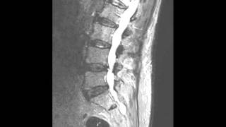 Lumbar Insufficiency Fracture [upl. by Ailicec]