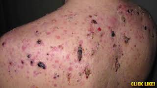 Worst Back Ance Pimple Popping Cysts amp Zits [upl. by Amelina]