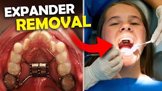 Getting Palatal Expander OFF… What happens when you get your Expander Off  McKinney Orthodontist [upl. by Shane695]