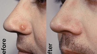 Mole removal Scarless procedure [upl. by Vilma]