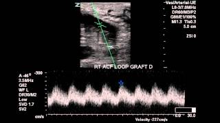 Right Arm AV Graft Duplex  Case Study [upl. by Leirbag]