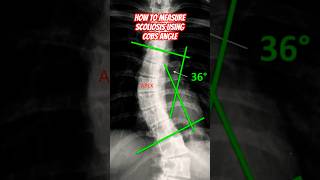 How to Measure Scoliosis 📐howto shorts doctor [upl. by Dez]