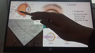 etiological classification of myopia part 3 BYNG MEDICALS [upl. by Nnep753]