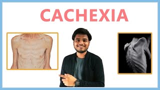 Cachexia wasting syndrome [upl. by Notlek225]