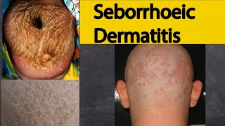 Seborrhoeic dermatitis  Explained under 3 minutes Seborrheic dermatitis Symptoms and treatment [upl. by O'Connor]