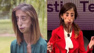 The ugliest girl of the world Lizzie Velásquez facts mysteriousfacts [upl. by Earvin]