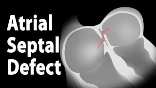 Atrial Septal Defect ASD Animation [upl. by Bonilla]