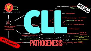 CHRONIC LYMPHOCYTIC LEUKEMIA Pathogenesis CLL Criteria Diagnosis Treatment [upl. by Busiek]