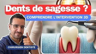 Comprendre l’Extraction DENTS DE SAGESSE [upl. by Keavy492]