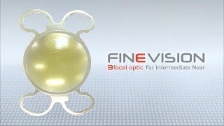 FineVision Trifocal Intraocular Lens [upl. by Andres]