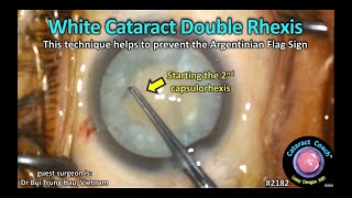 CataractCoach™ 2182 white cataract double rhexis technique [upl. by Adien136]