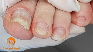 Toenail fungus cleaning [upl. by Vadnee]