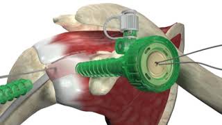 Biceptor Tenodesis System  Surgical Technique Walkthrough  SIMON MOYES [upl. by Conway]