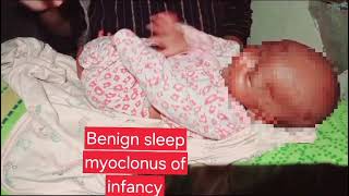 Benign sleep myoclonus  neonatal seizures  Signs symptoms and diagnosis  newborn fits  jhatky [upl. by Elgar]