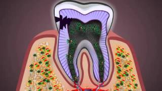 What is Pulpitis [upl. by Sanfo]