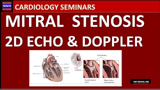 Mitral Stenosis By 2D Echo and Doppler Nik Nikam MD [upl. by Adnarim264]