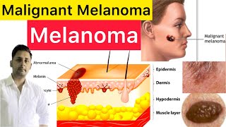 Malignant Melanoma Cause Risk Factors Types Diagnosis amp Treatment  What Is Malignant Melanoma [upl. by Aitnas]