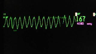 ventricular tachycardia  Torsade de Pointes on an ECG heart monitor [upl. by Combes]