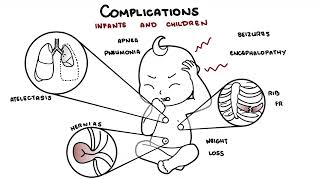 What is Pertussis and whooping cough  Bordetella pertussis symptoms pathophysiology and treatment [upl. by Gladdie]