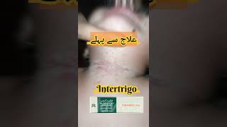 IntertrigoFungal infection of skin folds Pediatrics dermatology [upl. by Alethea]