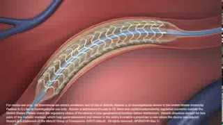 Simulacion Stent Coronario Biorreabsorbible Absorb de Abbott Vascular [upl. by Nahsaj]