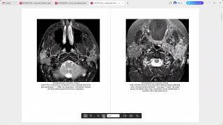 HEAD AND NECK EXPERT DDX [upl. by Chaker]