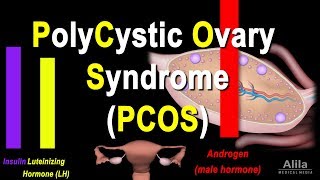 Polycystic Ovary Syndrome PCOS Pathology and Treatment Animation [upl. by Dede482]