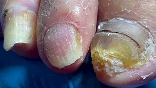 Onychomycosis infected the whole foot professional pedicure master【Pedicure Master Lin Jun】 [upl. by Imoian978]