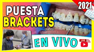 🔴 En Vivo Como se 𝗣𝗢𝗡𝗘𝗡 𝗟𝗢𝗦 𝗕𝗥𝗔𝗖𝗞𝗘𝗧𝗦 por PRIMERA VEZ  INSTALACIÓN de Brackets Paso A Paso 👌 [upl. by Malloch24]