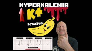 Why Hyperkalemia causes a widened QRS complex on the ECG  Explained [upl. by Thackeray]