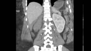 CT Abdomen Trauma w Hepatic laceration Discussed by Radiologist [upl. by Fleeman]