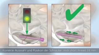 HBS 2 – Minimalinvasive palmare OPTechnik [upl. by Swagerty]