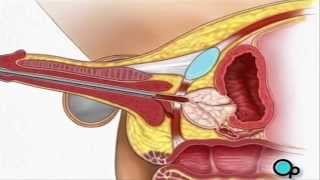 TURP Transurethral Resection Prostate penis Surgery  PreOp® Patient Education [upl. by Radmen]