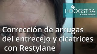 Corrección de arrugas del entrecejo y cicatrices con Restylane 18013 [upl. by Alram]