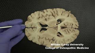 Horizontal slices of human forebrain neuroanatomy forebrain internal capsule caudate nucleus [upl. by Horner877]