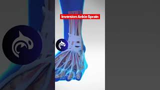 See the difference between both Eversion and Inversion Ankle Sprains in 3D Animation [upl. by Rudd872]