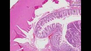 Histopathology Colon Adenocarcinoma [upl. by Annayr]